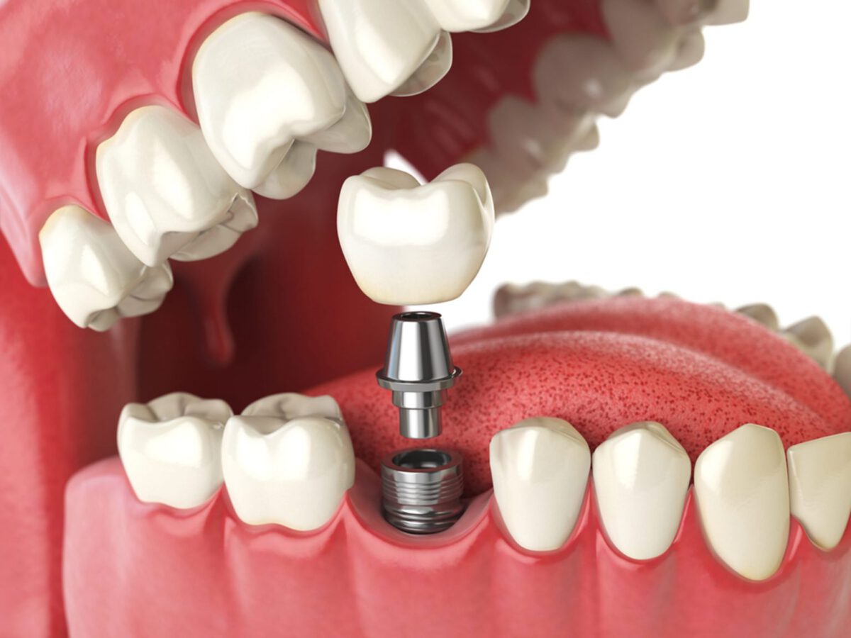 Dental Implants  – What Every Individual Should Look Into