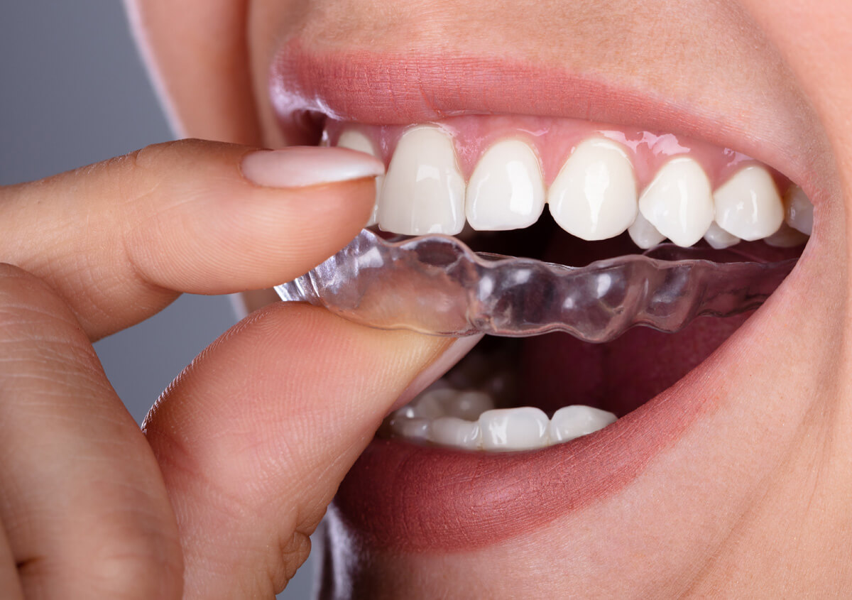 Complete Report On Dental Mouthguards